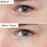 faces hyaluronic global
