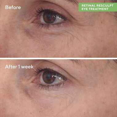 faces retinal resculpt