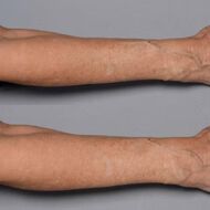 faces علاج تقوية الجلد بالبلازما الباردة