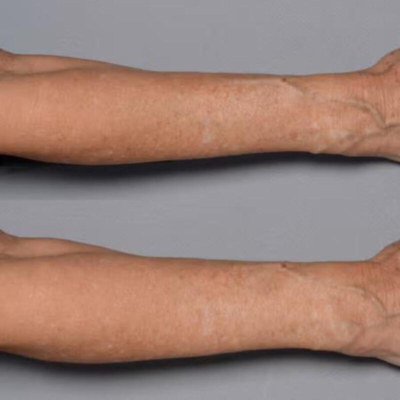 بيريكون إم دي علاج تقوية الجلد بالبلازما الباردة