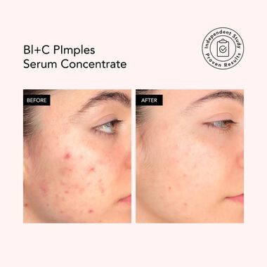 faces bl c pimples serum concentrate