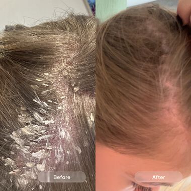 faces مجموعة مكافحة القشرة والخشونة